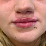 Cleft Lip Repair 