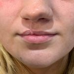 Cleft Lip Repair 