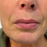 Lip Enhancement