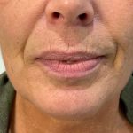 Lip Enhancement