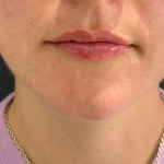 Lip Enhancement