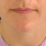 Lip Enhancement